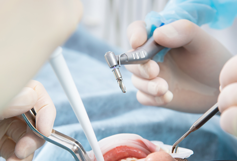 歯肉炎、歯周病の治療